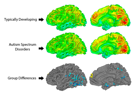 Brain images show local brain connections in typically developing adolescents and adolescents with Autism Spectrum Disorders (ASD). See bottom of story for detailed description.
