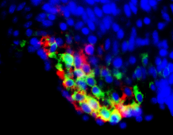 Cardiac progenitor cells (green) were infected by coxsackie virus (red).