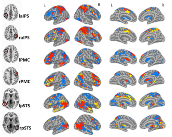 Some of Mller's previous studies have shown that there's more crosstalk between brain regions in children with Autism.