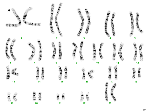 A deletion at one end of chromosome 11 is responsible for Jacobsen syndrome.