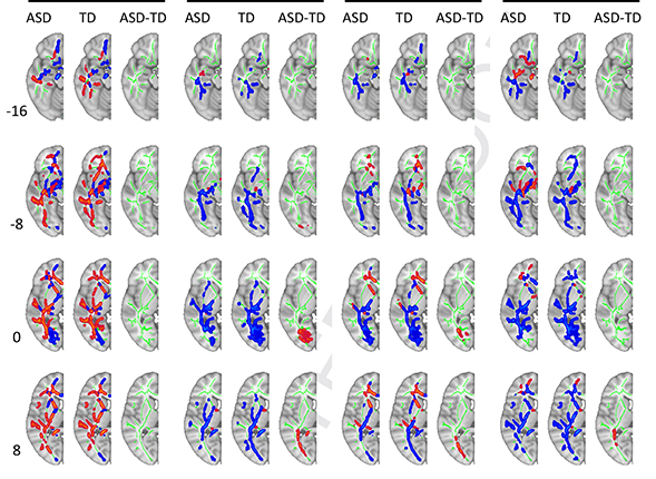 MRI scans revealed that connections between white matter in the brains of young people with autism were more symmetrical across hemispheres. (Credit: Ralph-Axel Mller)